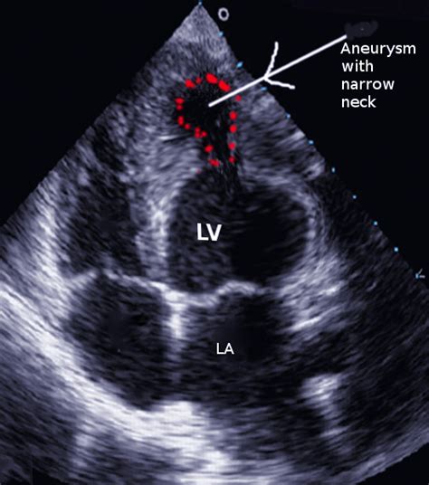 lv aneurysm vs pseudoaneurysm echo